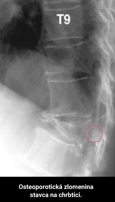 Röntgenová snímka osteoporotickej zlomeniny stavca na chrbtici.